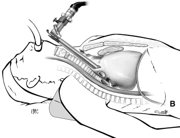 Interventions En Chirurgie Thoracique Mon Bloc Op ratoire interventions-en-chirurgie-thoracique-mon-bloc-op-ratoire